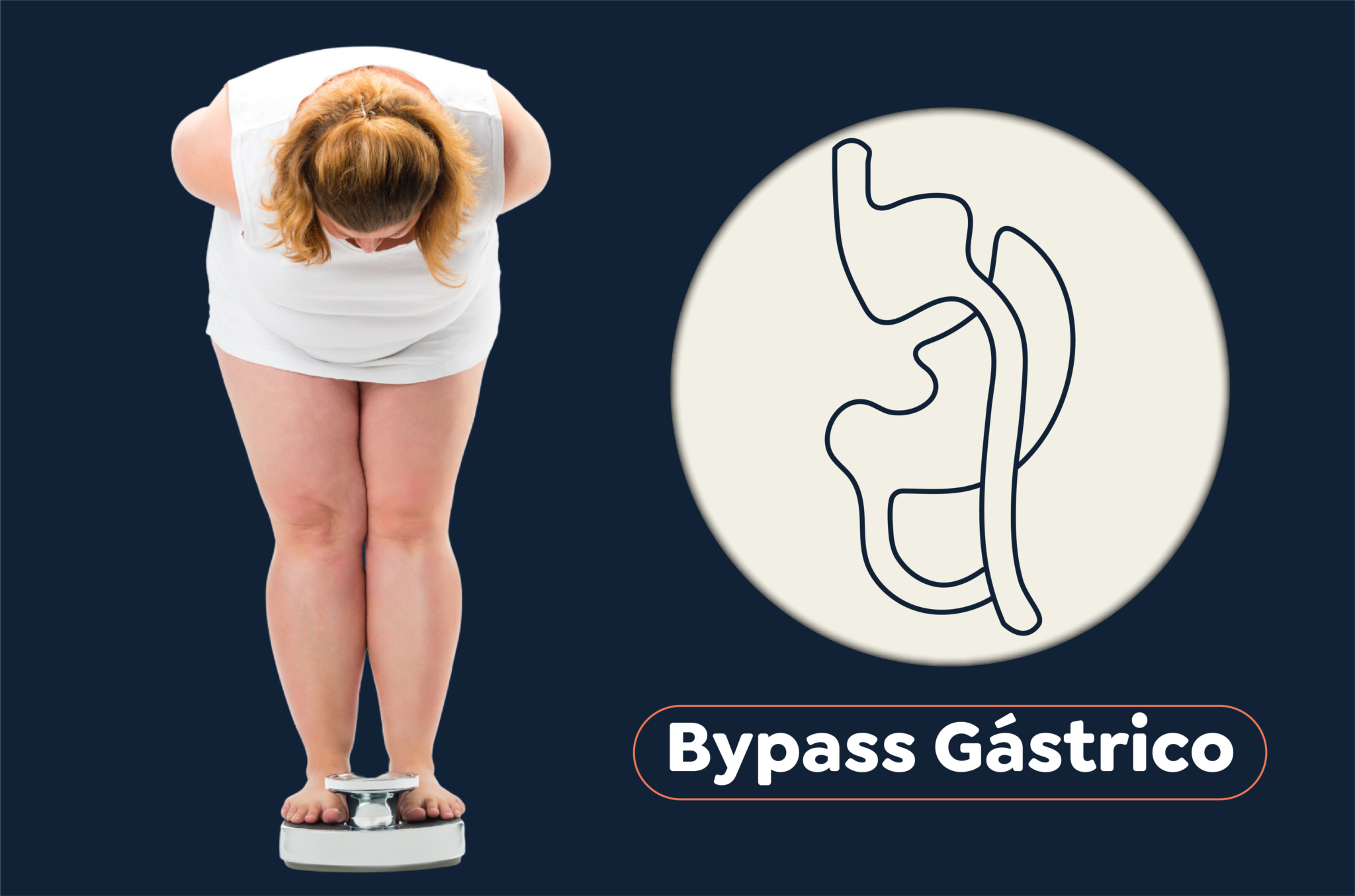 Por Qu Realizarse Un Bypass Gastrico En Bogota Cirug A