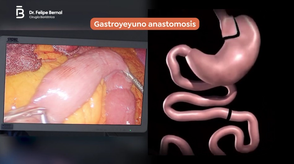 Gastroyeyuno anastomosis bypass gástrico 2