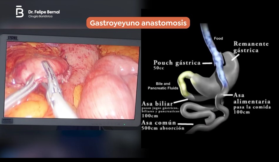 Gastroyeyuno anastomosis bypass gástrico 3