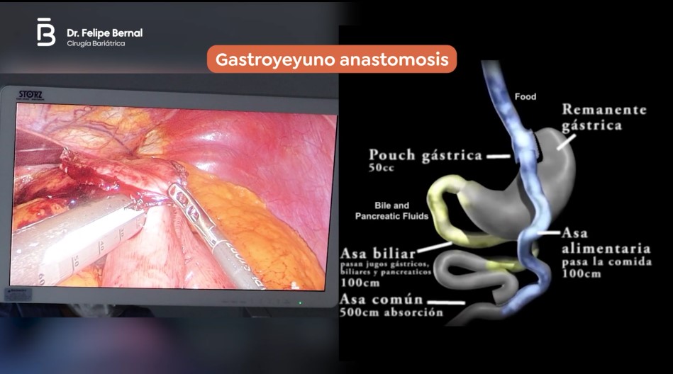 Gastroyeyuno anastomosis bypass gástrico 4