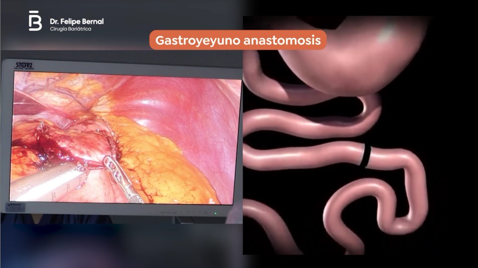 Gastroyeyuno anastomosis bypass gástrico 5