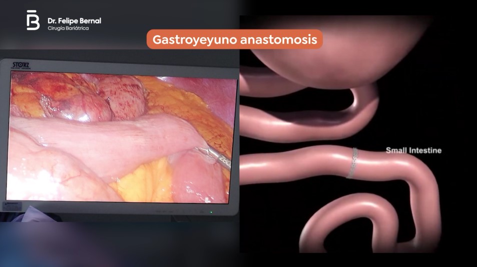 Gastroyeyuno anastomosis bypass gástrico