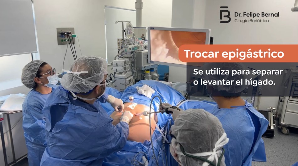 Trocar epigástrico Bypass