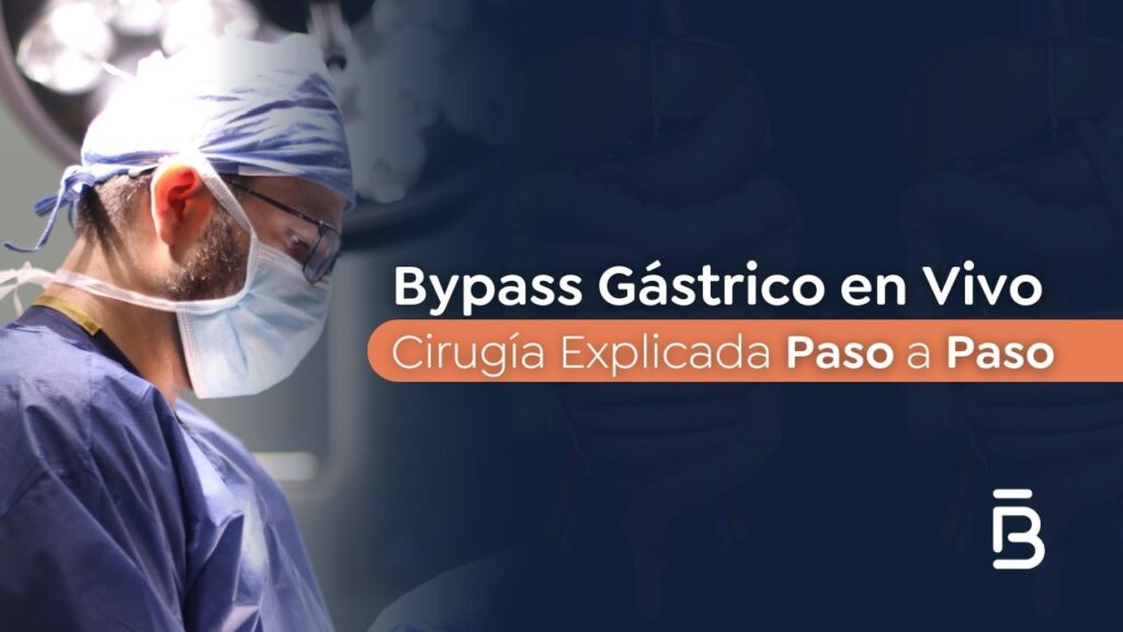 Video de Bypass Gástrico