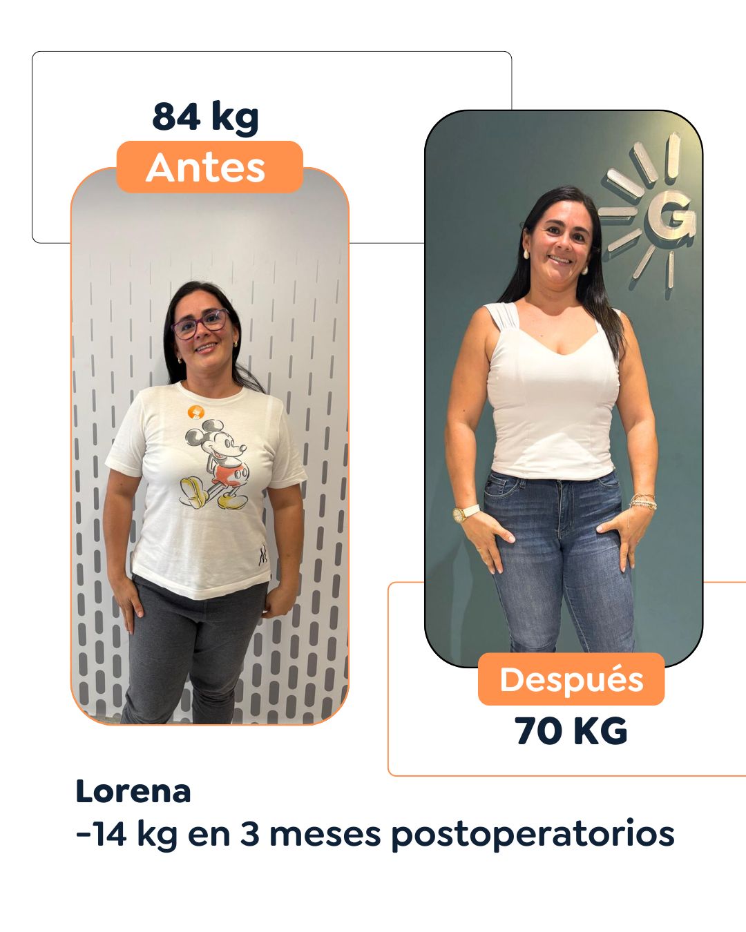 Antes y después Cirugía Bariátrica en Bogotá Dr. Felipe Bernal.