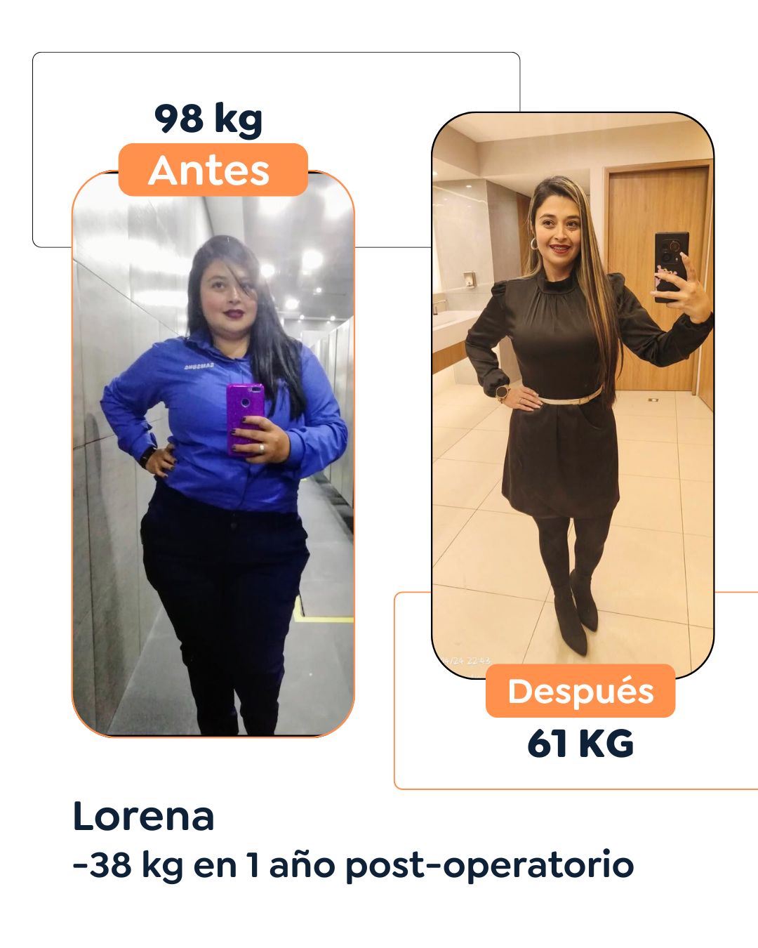 Antes y después Cirugía Bariátrica en Bogotá Dr. Felipe Bernal - Manga gástrica antes y después - Bypass Gástrico Antes y después