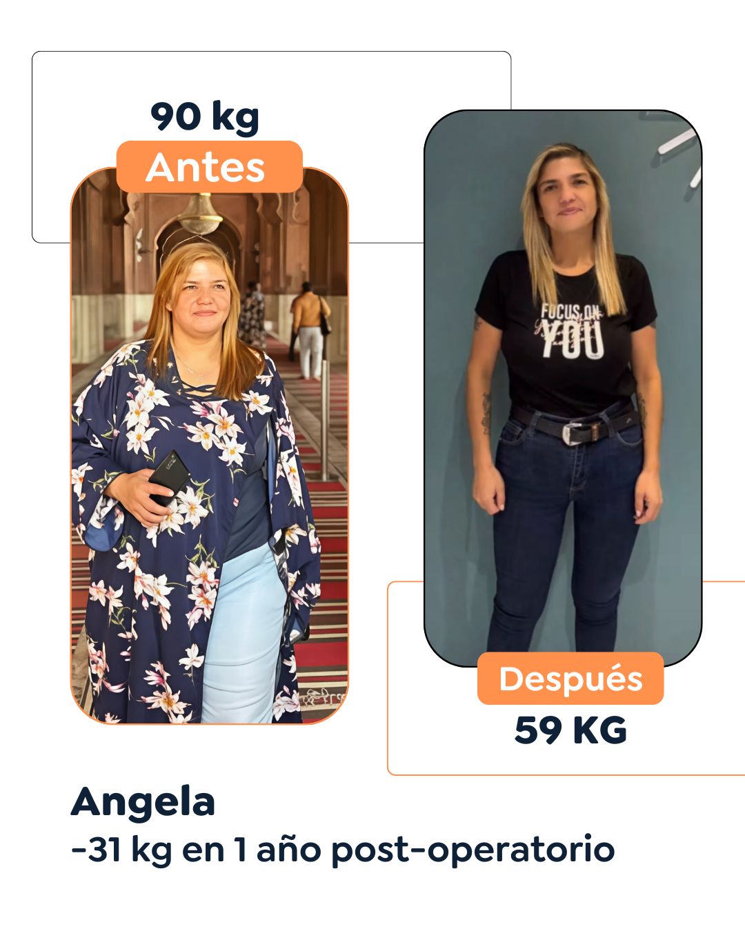 Antes y después Cirugía Bariátrica en Bogotá Dr. Felipe Bernal - Manga gástrica antes y después - Bypass Gástrico Antes y después