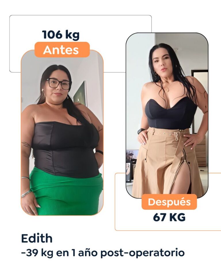 Antes y después Cirugía Bariátrica en Bogotá Dr. Felipe Bernal - Manga gástrica antes y después - Bypass Gástrico Antes y después