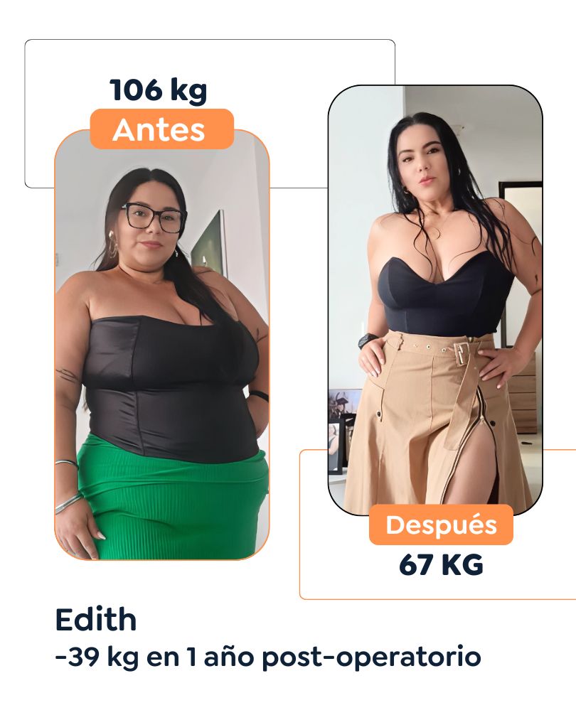 Antes y después Cirugía Bariátrica en Bogotá Dr. Felipe Bernal - Manga gástrica antes y después - Bypass Gástrico Antes y después
