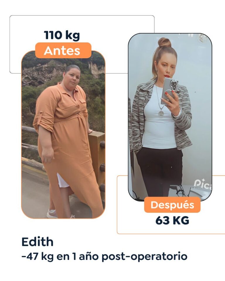 Antes y después Cirugía Bariátrica en Bogotá Dr. Felipe Bernal - Manga gástrica antes y después - Bypass Gástrico Antes y después