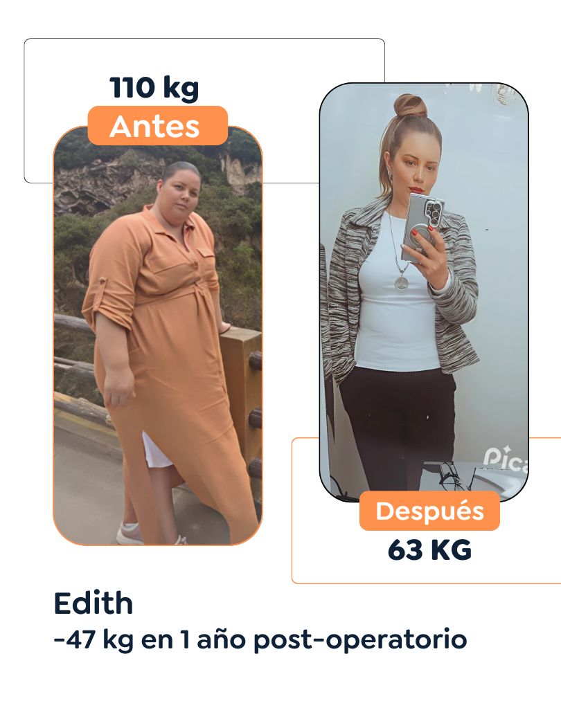 Antes y después Cirugía Bariátrica en Bogotá Dr. Felipe Bernal - Manga gástrica antes y después - Bypass Gástrico Antes y después