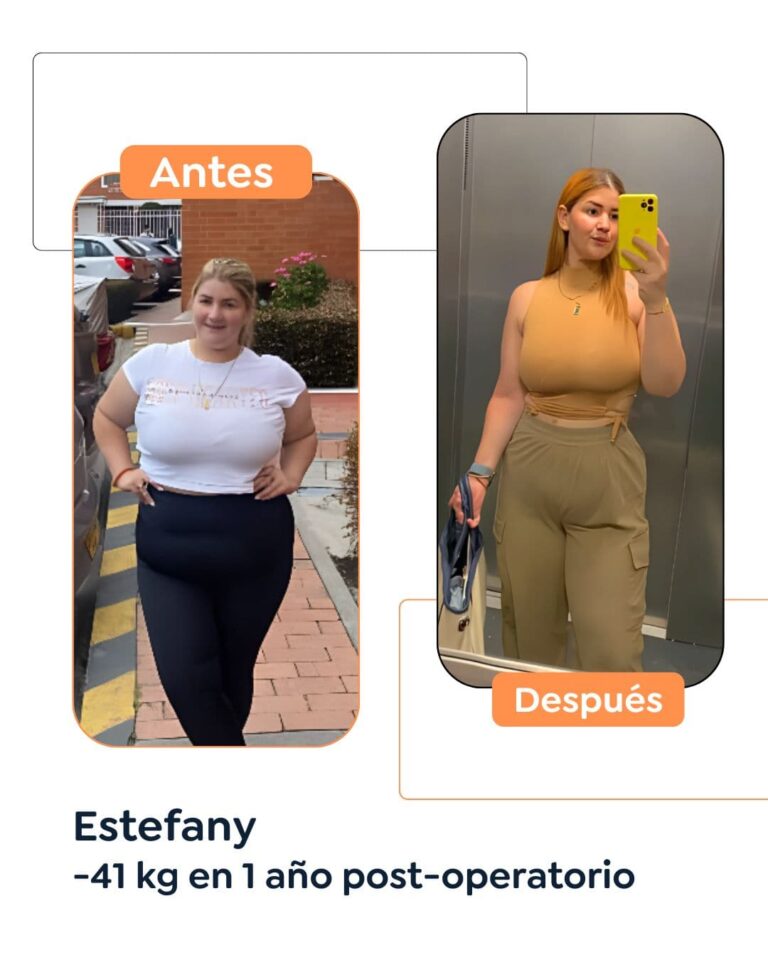 Antes y después Cirugía Bariátrica en Bogotá Dr. Felipe Bernal - Manga gástrica antes y después - Bypass Gástrico Antes y después 2