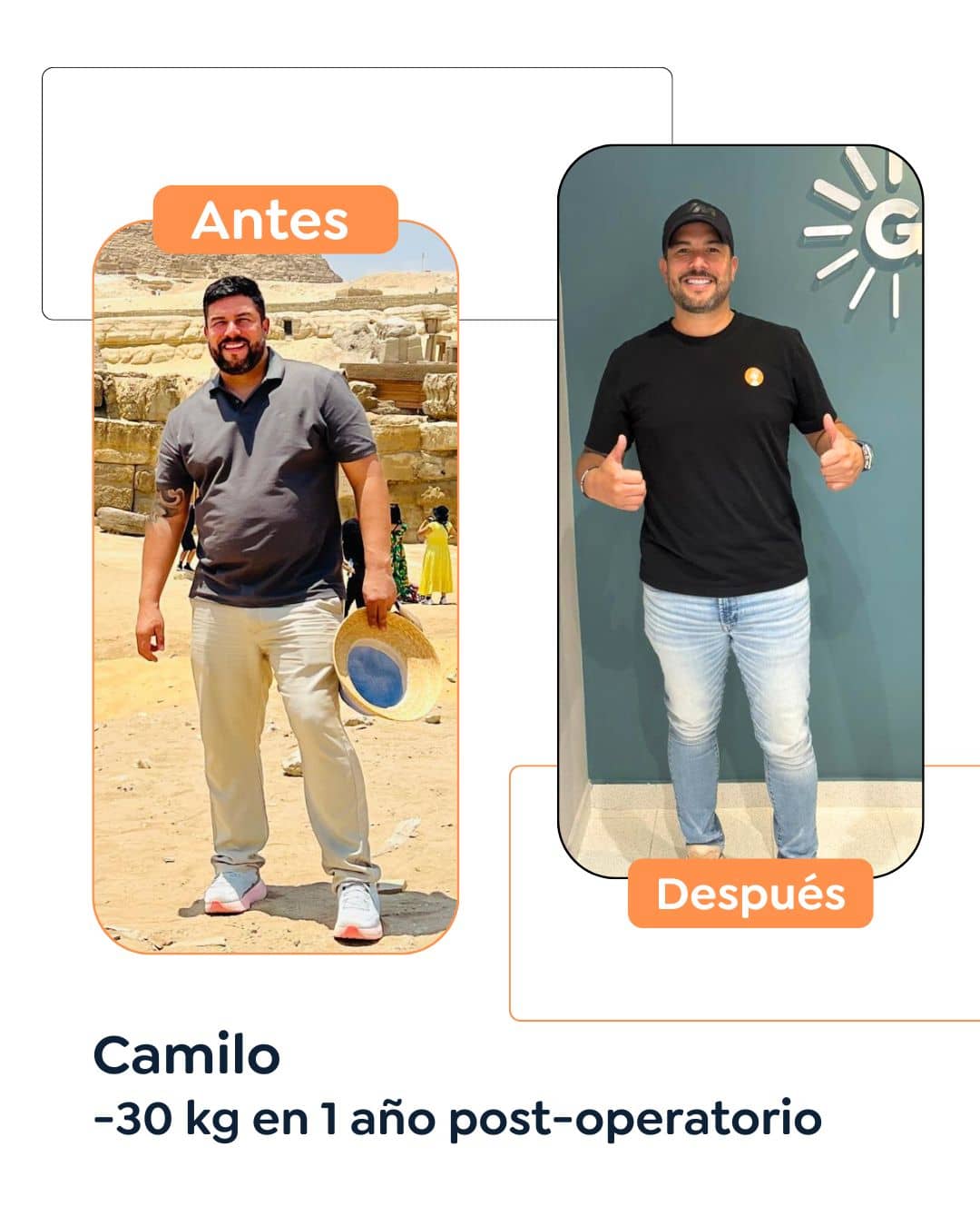 Antes y después Cirugía Bariátrica en Bogotá Dr. Felipe Bernal - Manga gástrica antes y después - Bypass Gástrico Antes y después 3