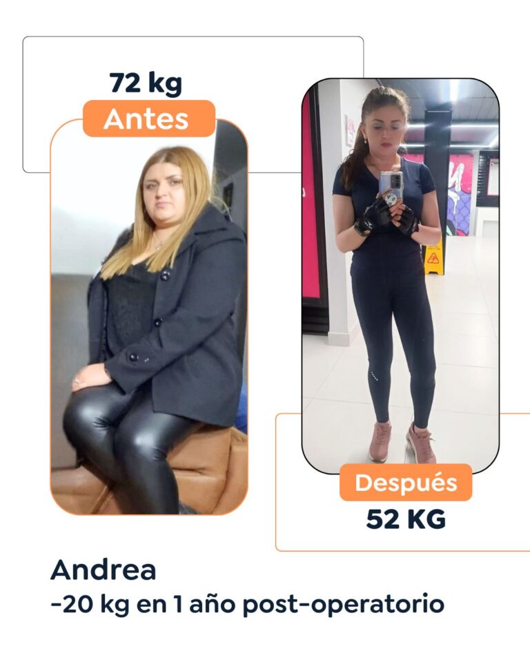 Antes y después de cirugía bariátrica en Bogotá con el Dr. Felipe Bernal - 011025 4