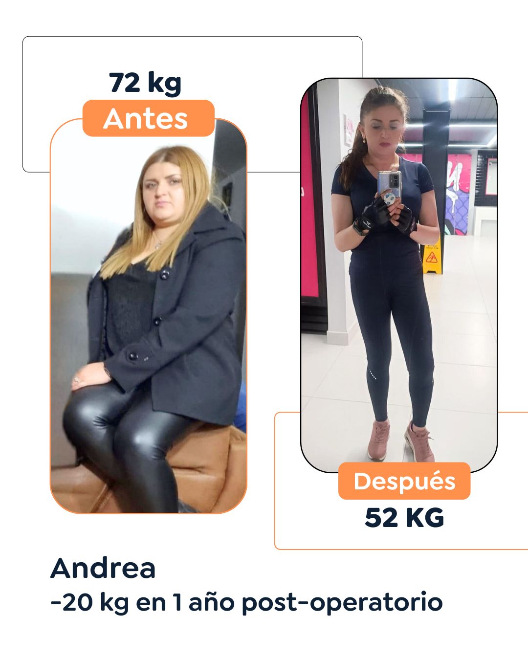 Antes y después de cirugía bariátrica en Bogotá con el Dr. Felipe Bernal - 011025 4