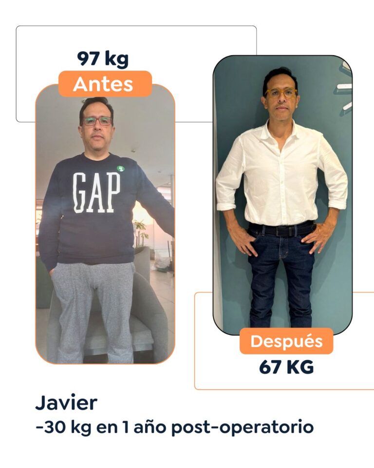 Antes y después de cirugía bariátrica en Bogotá con el Dr. Felipe Bernal - 011125 2