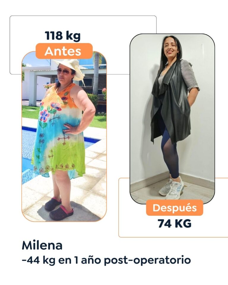 Antes y después de cirugía bariátrica en Bogotá con el Dr. Felipe Bernal - 011125