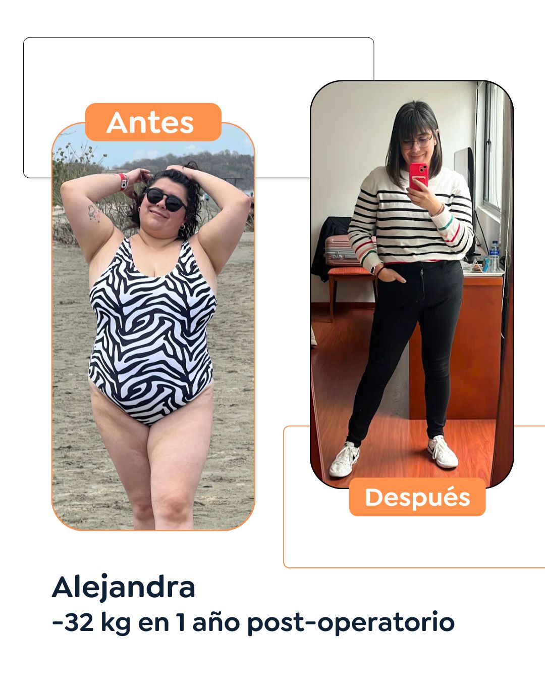 Antes y después de cirugía bariátrica en Bogotá con el Dr. Felipe Bernal - 011225 3