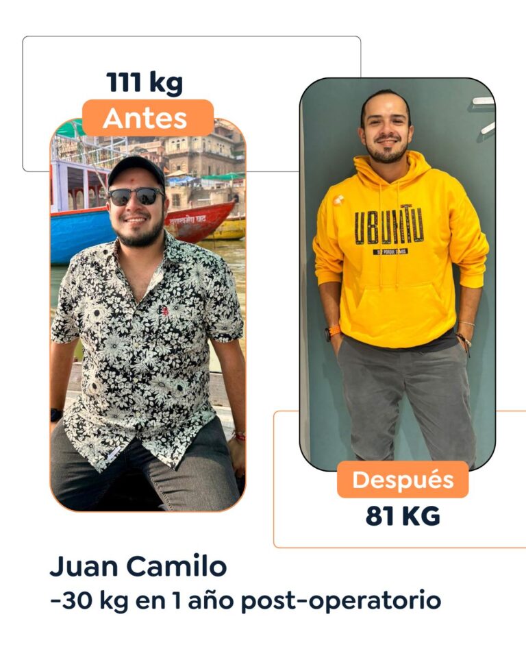 Antes y después de cirugía bariátrica en Bogotá con el Dr. Felipe Bernal - 011225