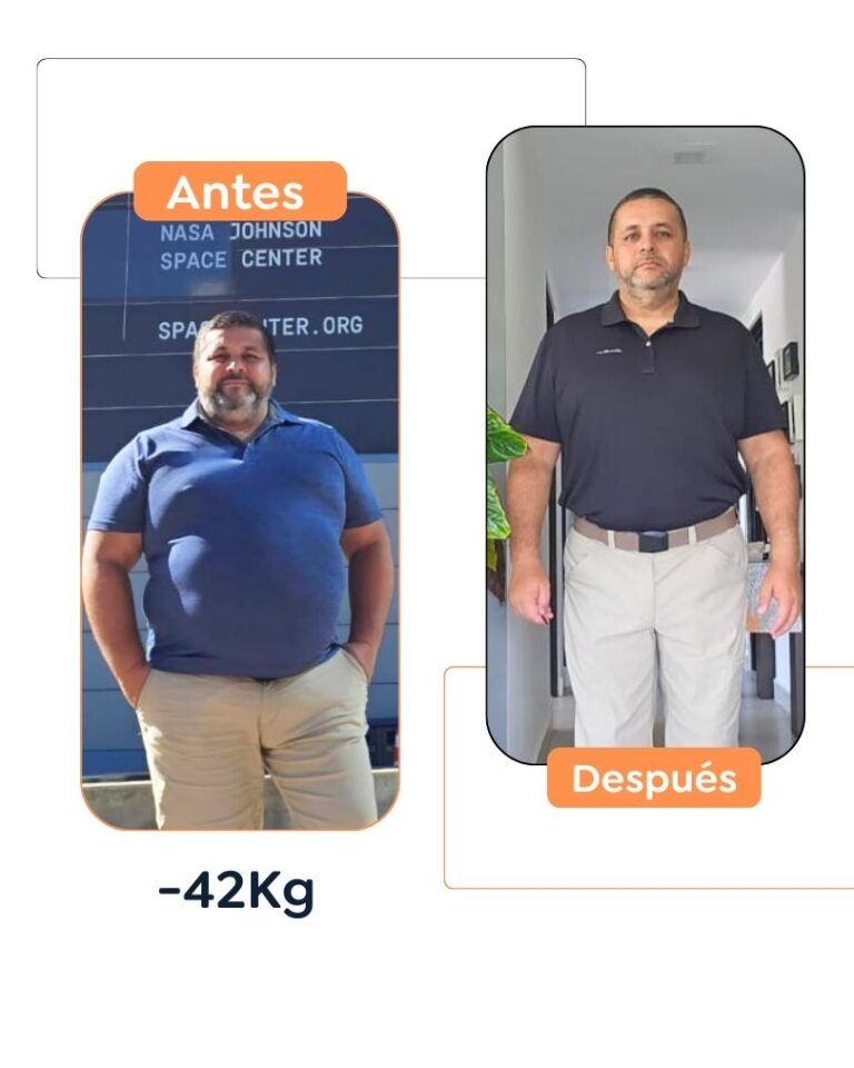 Antes y después de una cirugía bariátrica en Bogotá - Dr. Felipe Bernal