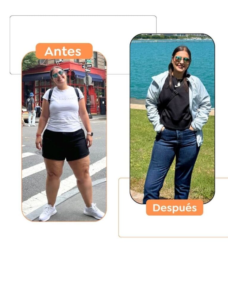 Antes y después de una cirugía bariátrica en Bogotá - Dr. Felipe Bernal