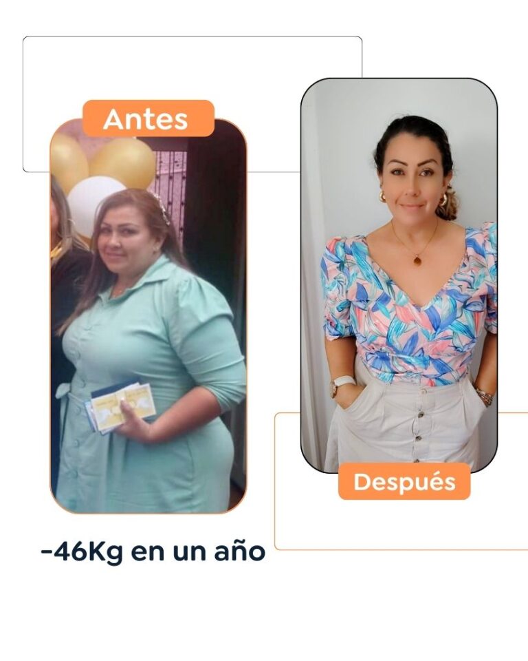 Antes y después de una cirugía bariátrica en Bogotá - Dr. Felipe Bernal
