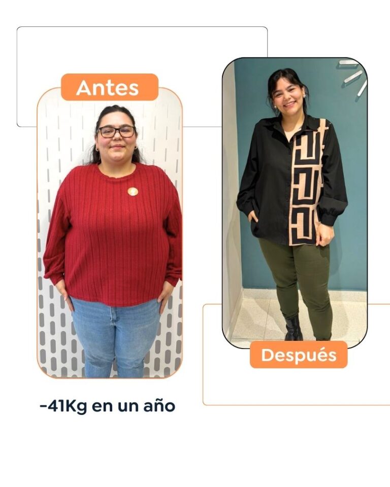 Antes y después de una cirugía bariátrica en Bogotá - Dr. Felipe Bernal