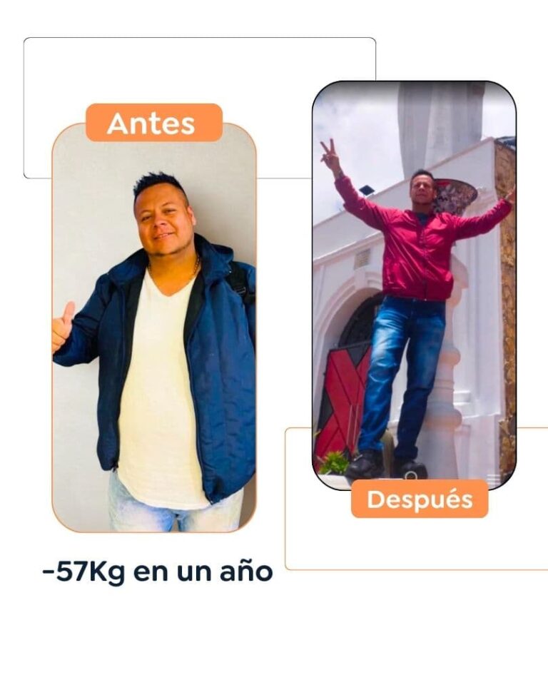 Antes y después de una cirugía bariátrica en Bogotá - Dr. Felipe Bernal