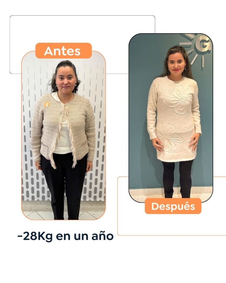 Antes y después de una cirugía bariátrica en Bogotá - Dr. Felipe Bernal