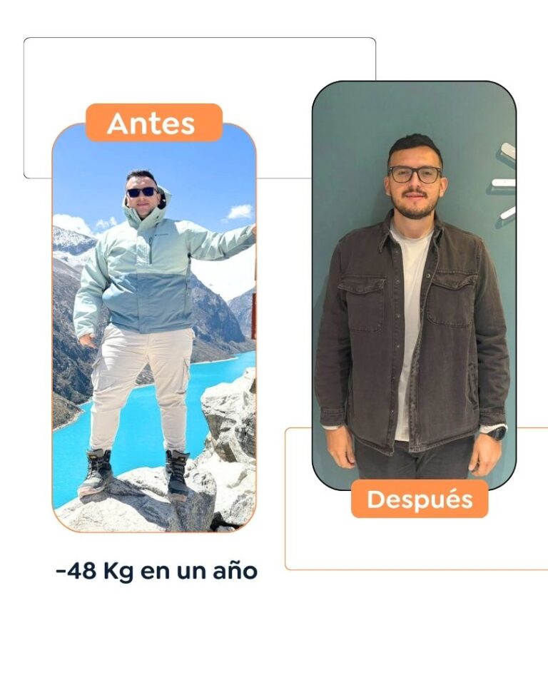 Antes y después de una cirugía bariátrica en Bogotá - Dr. Felipe Bernal