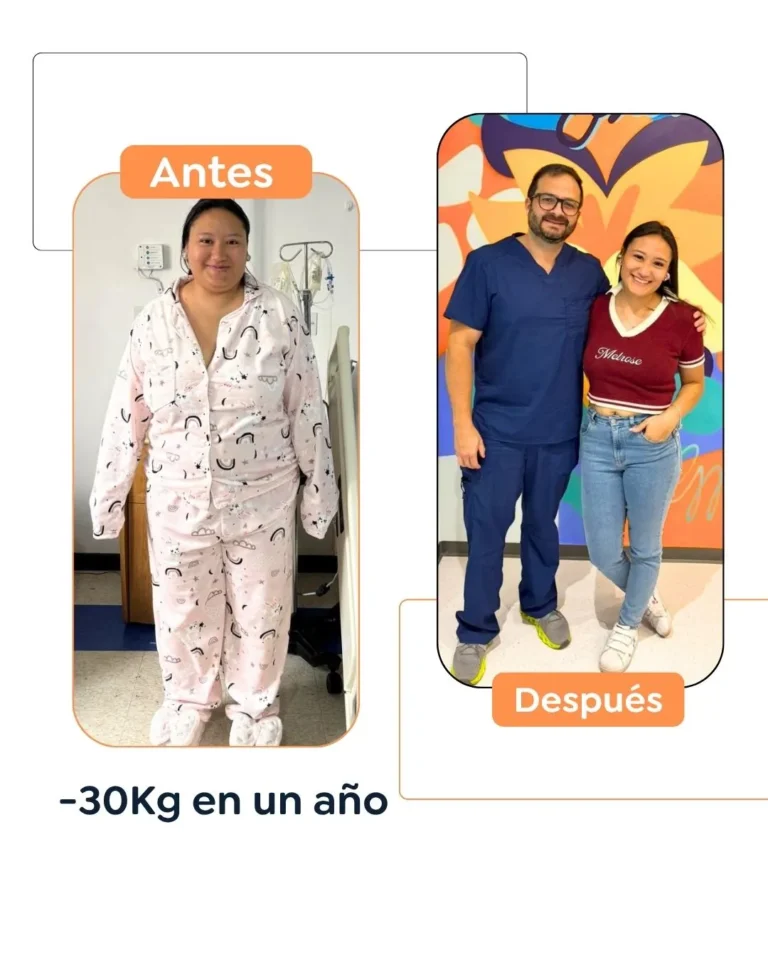 Antes y después de una cirugía bariátrica en Bogotá - Dr. Felipe Bernal - Dr Felipe Bernal