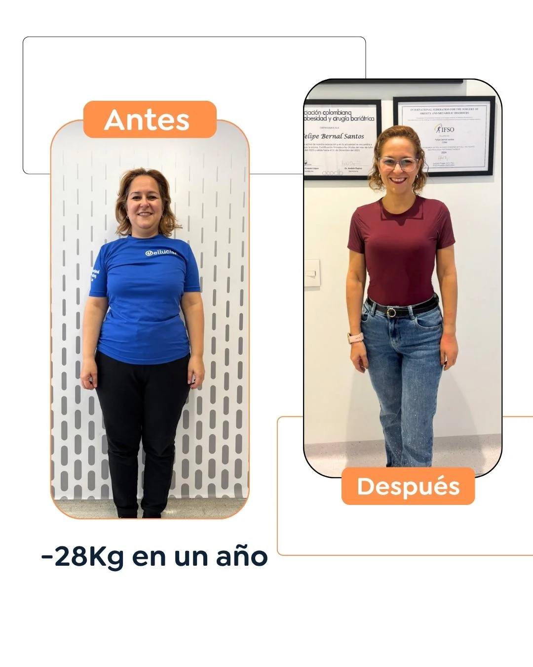 Antes y después de una cirugía bariátrica en Bogotá - Dr. Felipe Bernal - Dr Felipe Bernal