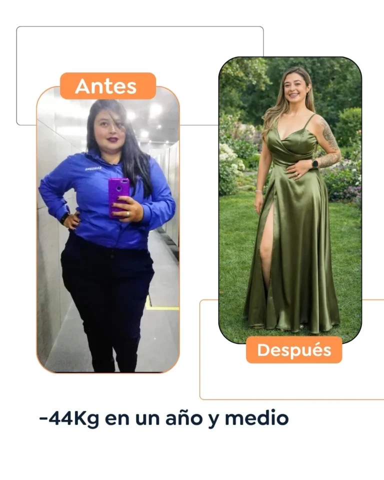 Antes y después de una cirugía bariátrica en Bogotá - Dr. Felipe Bernal - Dr Felipe Bernal
