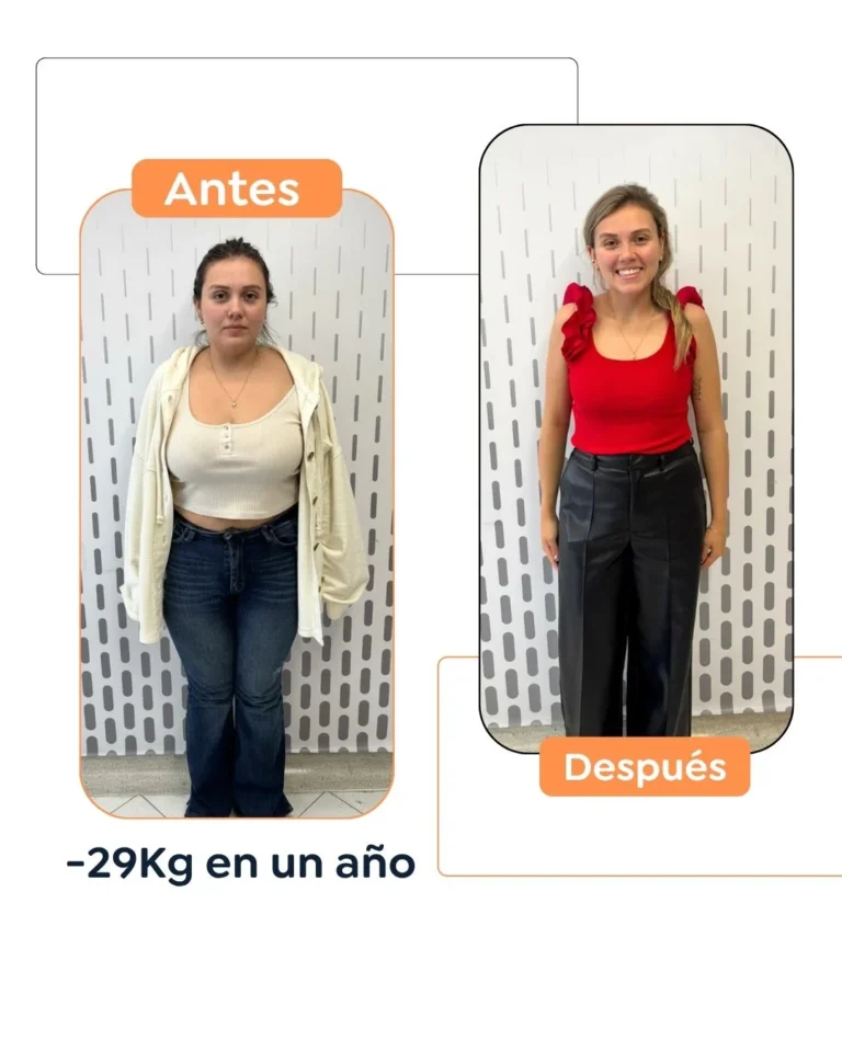 Antes y después de una cirugía bariátrica en Bogotá - Dr. Felipe Bernal - Dr Felipe Bernal