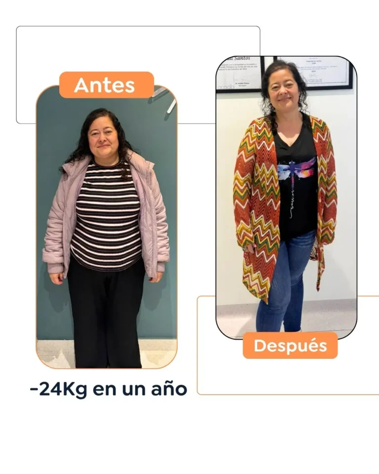 Cirugía bariátrica antes y después en Bogotá, Colombia - Dr. Felipe Bernal - Manga gástrica - Bypass gástrico 03082026 1
