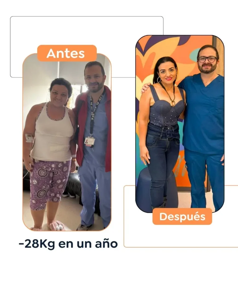 Cirugía bariátrica antes y después en Bogotá, Colombia - Dr. Felipe Bernal - Manga gástrica - Bypass gástrico 03082026 2