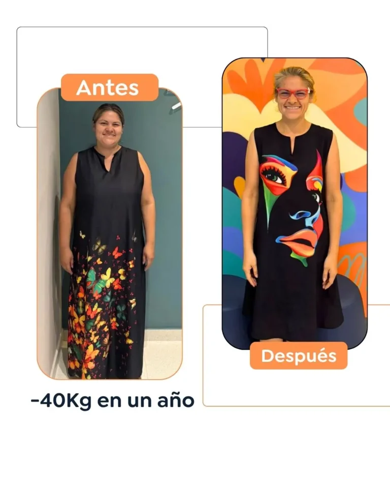 Cirugía bariátrica antes y después en Bogotá, Colombia - Dr. Felipe Bernal - Manga gástrica - Bypass gástrico 03082026 3