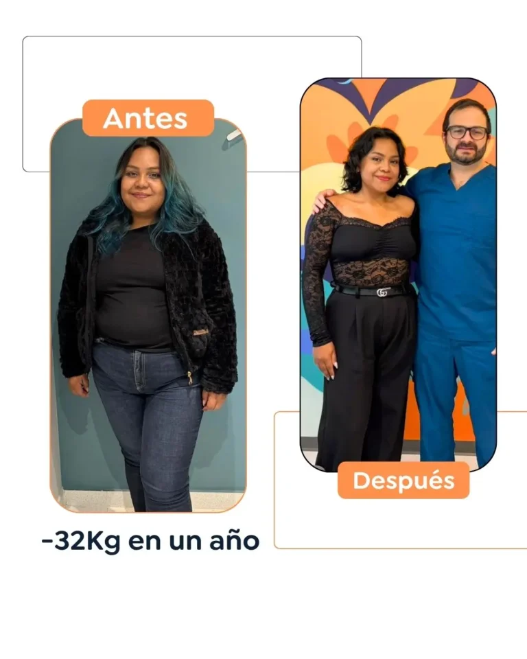 Cirugía bariátrica antes y después en Bogotá, Colombia - Dr. Felipe Bernal - Manga gástrica - Bypass gástrico 03082026